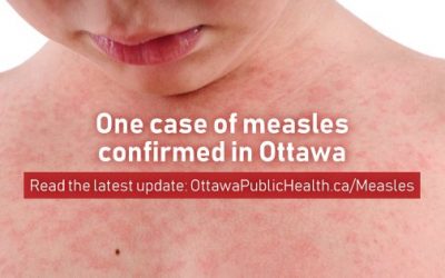 UPDATE: One case of measles confirmed in Ottawa